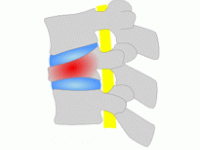złamanie osteoporotyczne